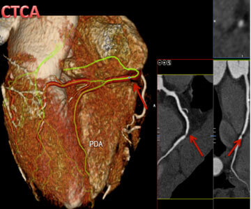 United Cardiology CT Coronary Angiogram