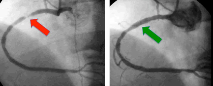 United Cardiology Coronary Angiography +/- Angioplasty and Stenting